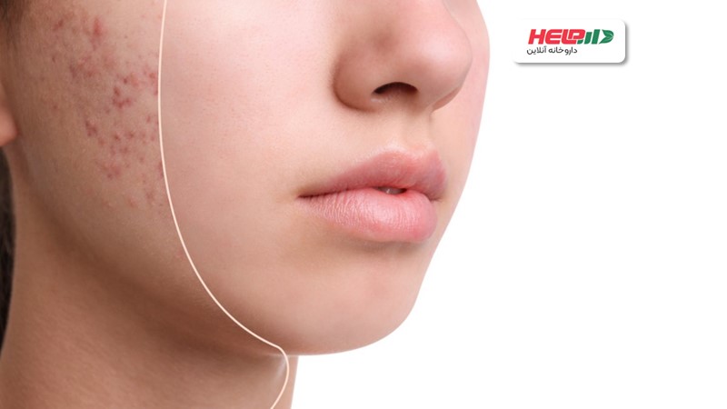 7 راهکار خانگی برای رفع جوش صورت