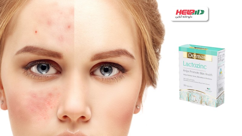 لاکتوزینک؛ بهترین راه برطرف کردن آکنه و جوش
