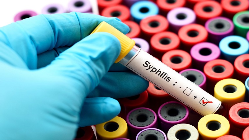 سیفیلیس (Syphilis)
